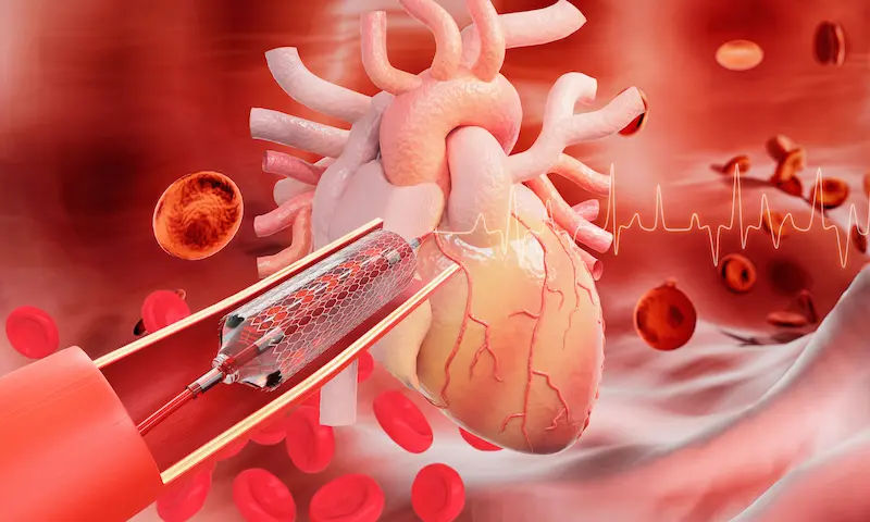 Is Angioplasty Necessary After Angiography